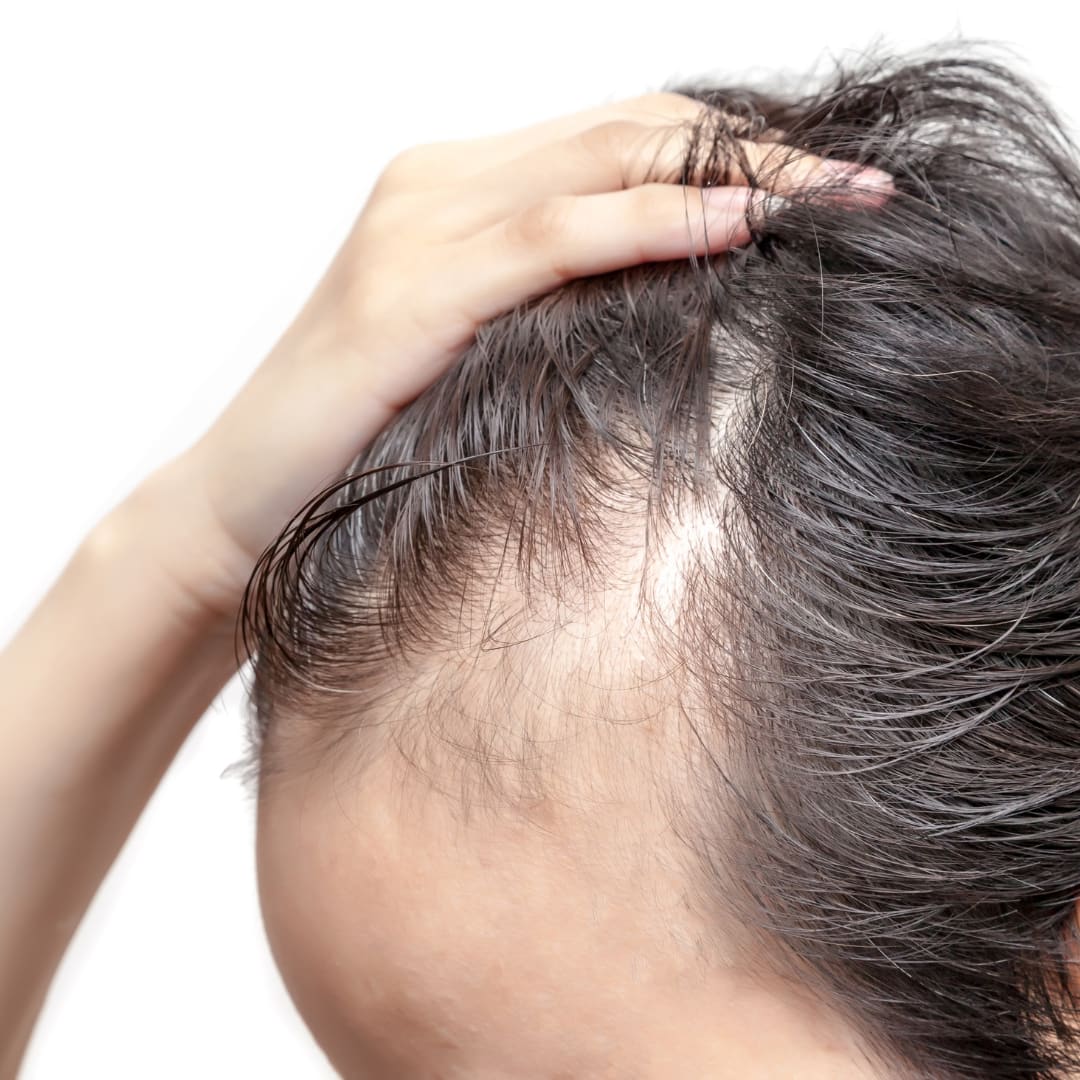 Understanding ALOPECIA or HAIR LOSS!