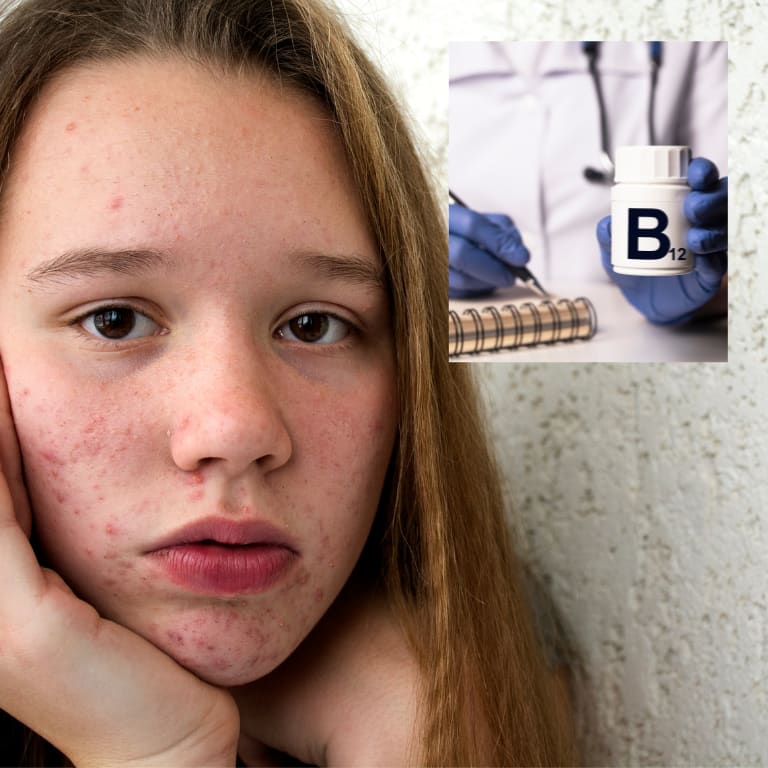 VITAMIN B12 Supplements leading to ACNE BREAKOUTS??