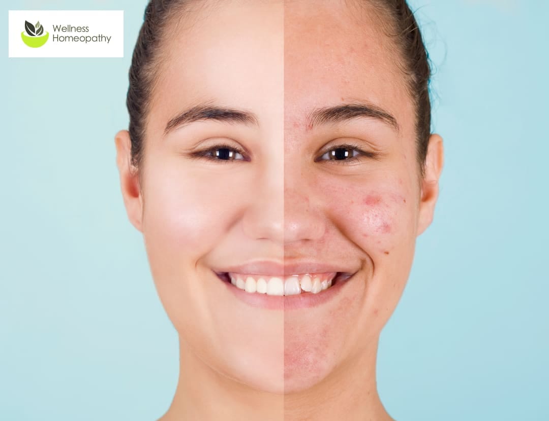 Holistic acne solutions with Wellness Homeopathy