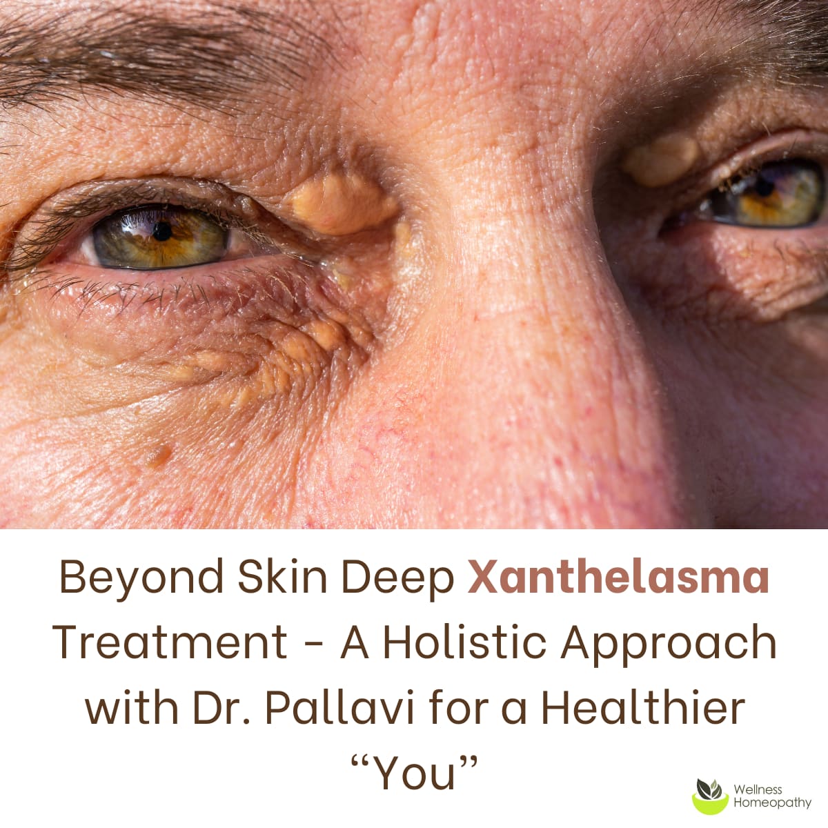 Beyond Skin Deep Xanthelasma Treatment – A Holistic Approach with Dr. Pallavi for a Healthier “You”