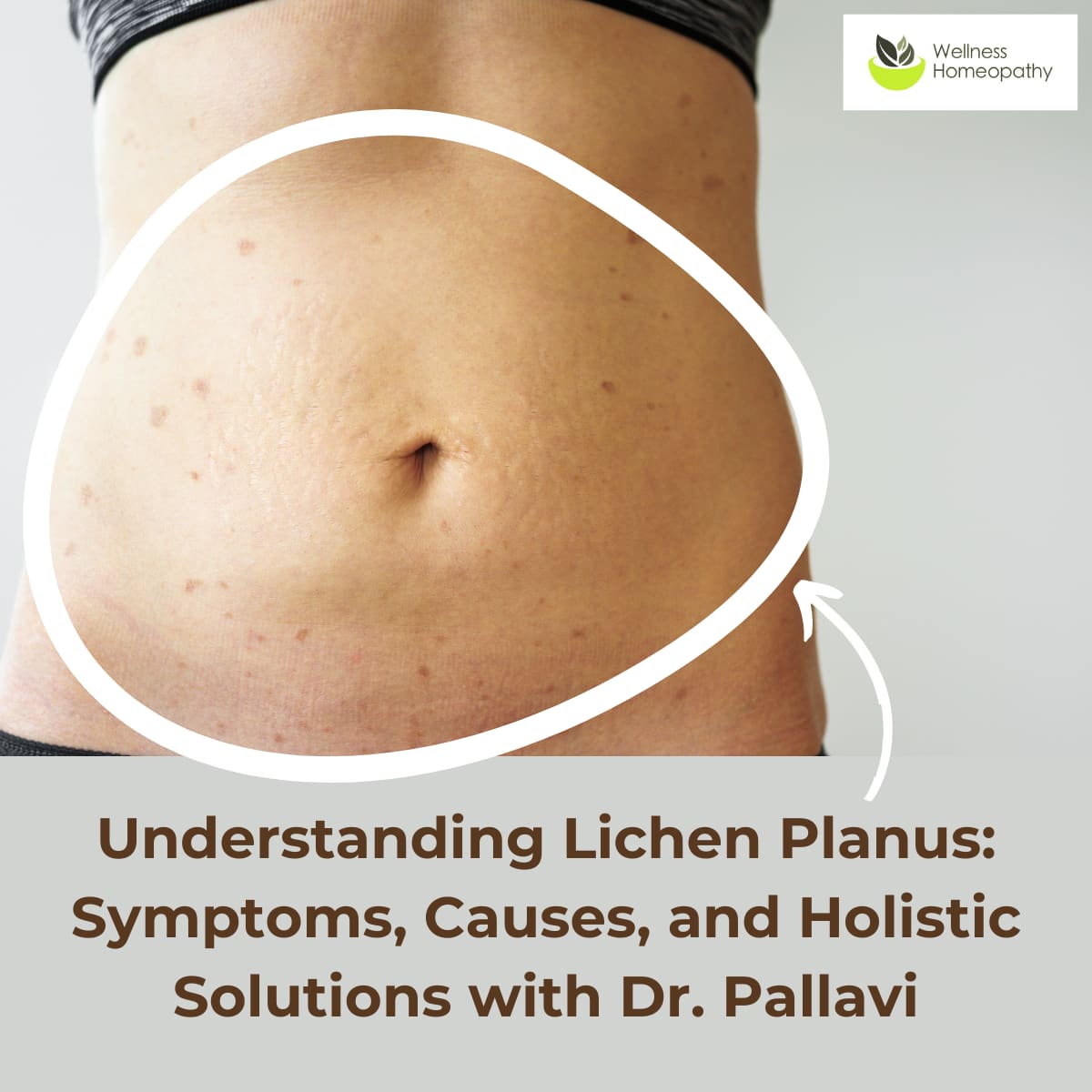 Understanding Lichen Planus: Symptoms, Causes, and Holistic Solutions with Dr. Pallavi