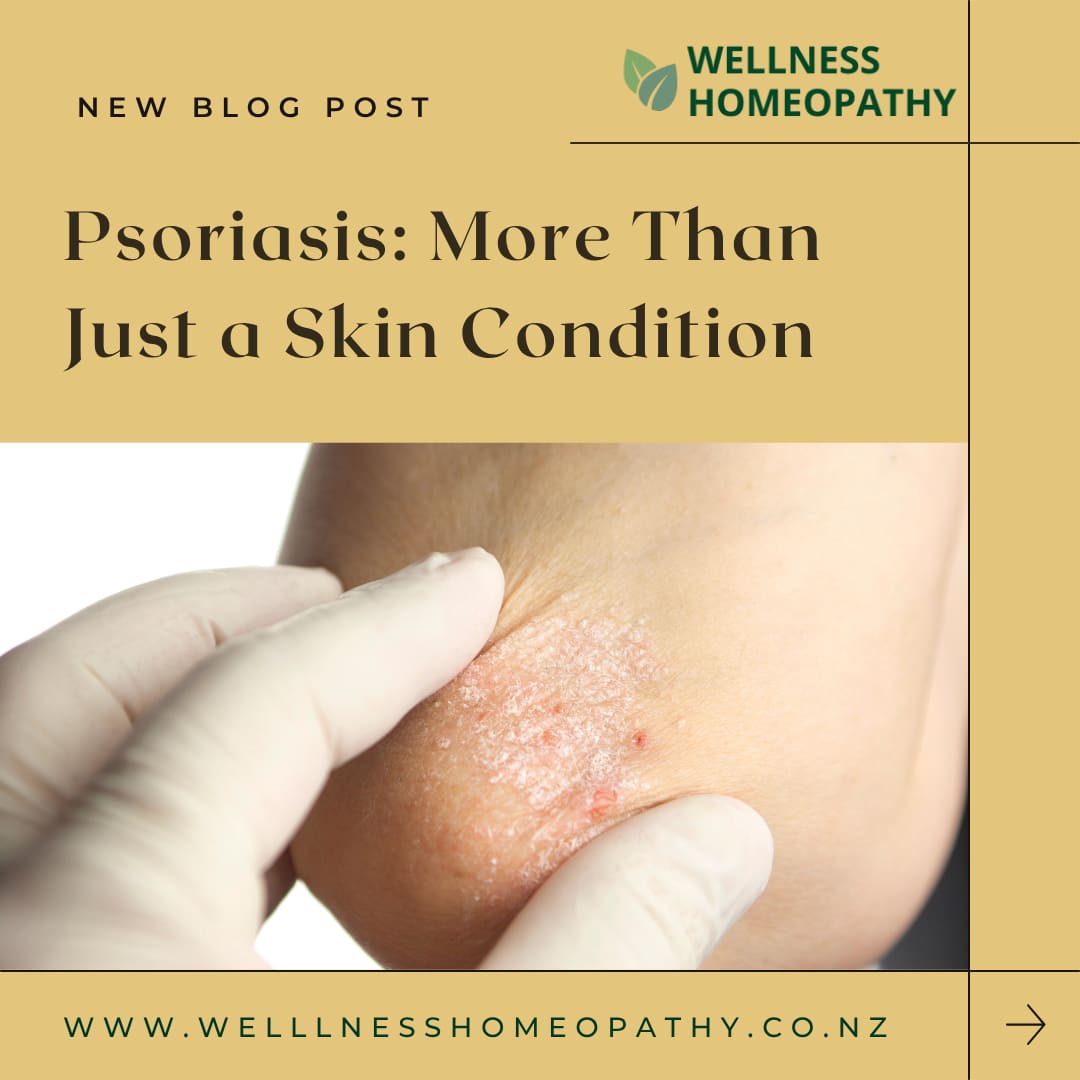 Psoriasis: More Than Just a Skin Condition
