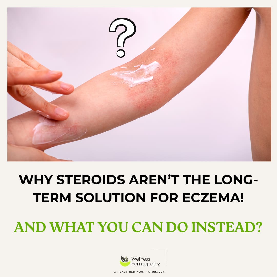 Why Steroids Aren’t the Long-Term Solution for Eczema! And What You Can Do Instead?