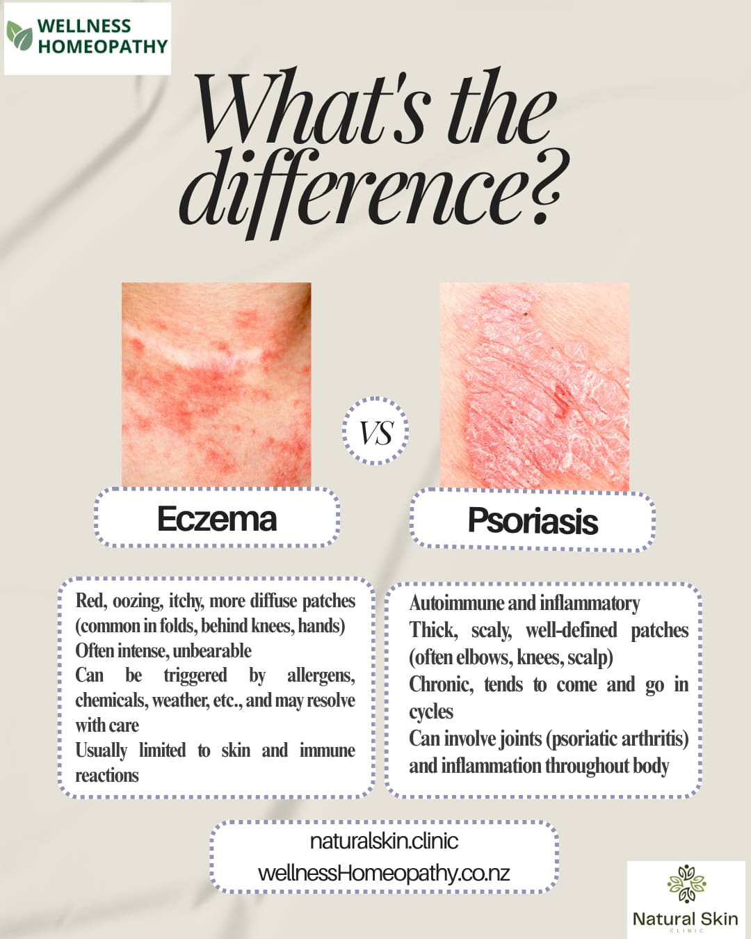 What Exactly Is Psoriasis — and How Is It Different from Eczema or Dermatitis?