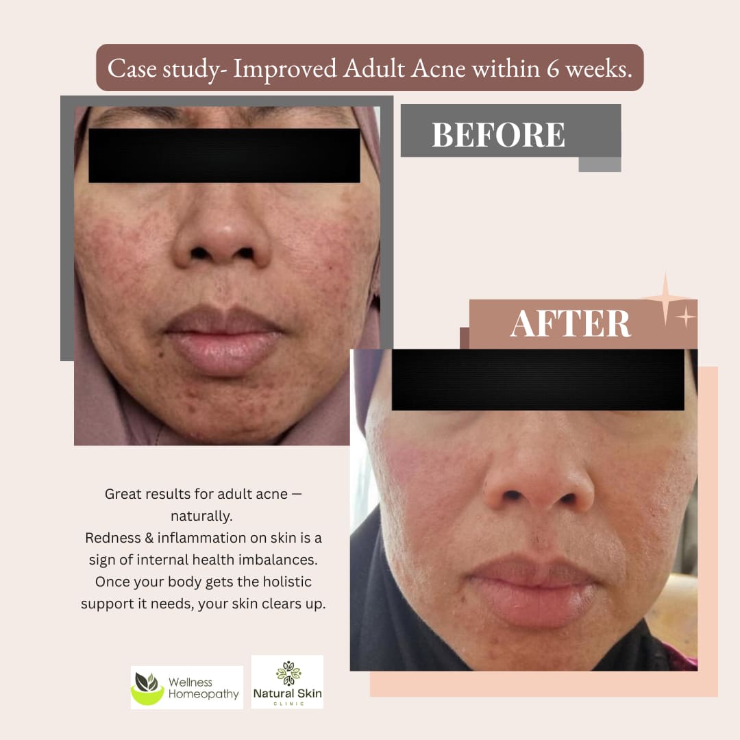Adult Acne: Why It Happens & How Homeopathy Helps You Heal Naturally?